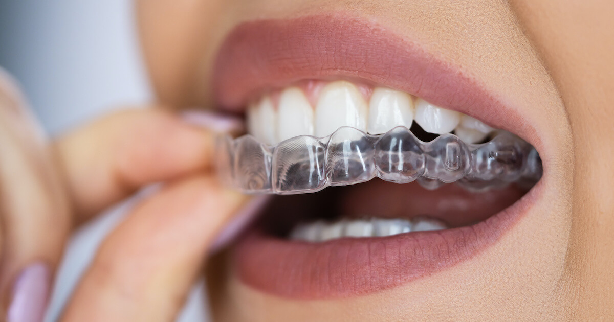 Tratamento Invisalign